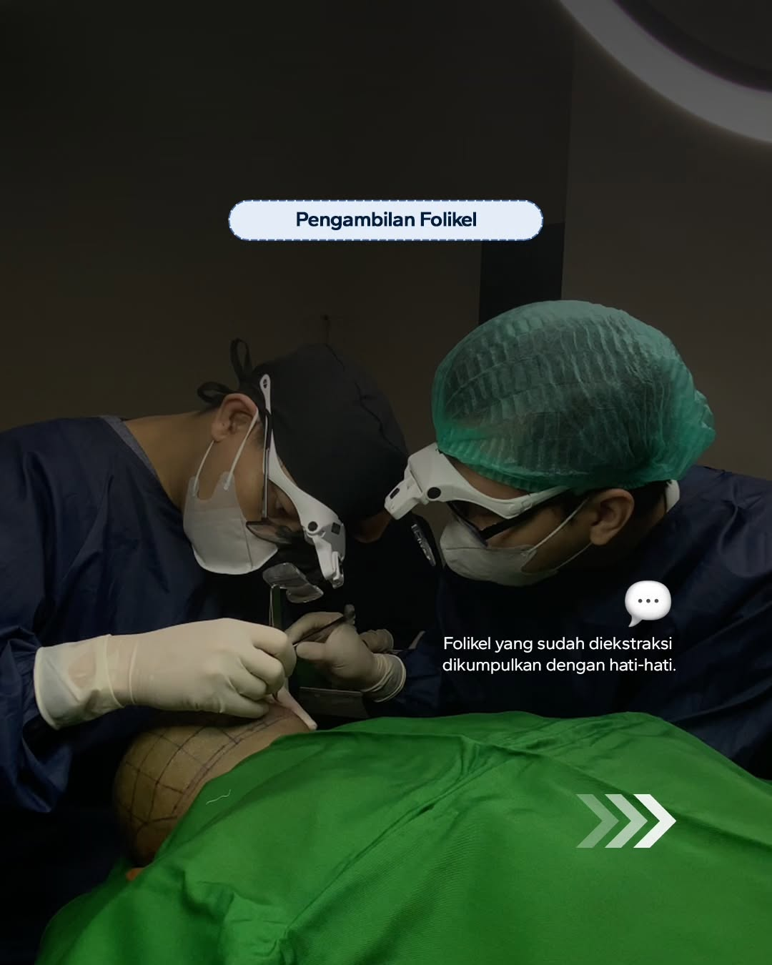 Berapa lama proses Hair Transplant?